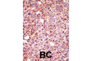 Formalin-fixed and paraffin-embedded human cancer tissue reacted with MGAT3 polyclonal antibody  , which was peroxidase-conjugated to the secondary antibody, followed by AEC staining . (MGAT3 抗体  (N-Term))
