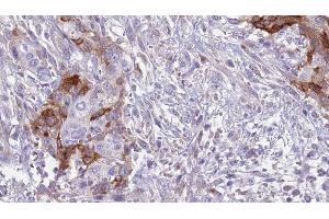 ABIN6277553 at 1/100 staining Human urothelial cancer tissue by IHC-P. (CD42a 抗体  (Internal Region))