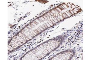 ABIN6267547 at 1/200 staining human colon cancer tissue sections by IHC-P. (VASP 抗体  (pSer239))