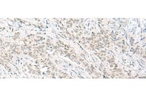 Immunohistochemistry of paraffin-embedded Human ovarian cancer tissue using HABP4 Polyclonal Antibody at dilution of 1:60(x200) (HABP4 抗体)