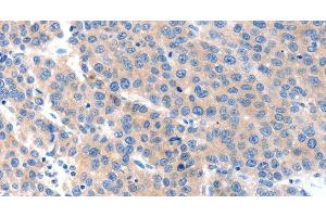 Immunohistochemistry of paraffin-embedded Human liver cancer tissue using KLK2 Polyclonal Antibody at dilution 1:100 (Kallikrein 2 抗体)