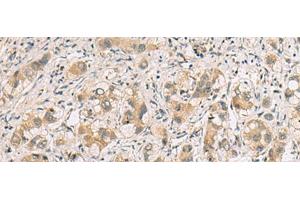Immunohistochemistry of paraffin-embedded Human liver cancer tissue using RTP4 Polyclonal Antibody at dilution of 1:80(x200) (RTP4 抗体)