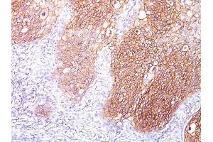 Formalin-fixed, paraffin-embedded human Lung SqCC stained with EGFR Mouse Monoclonal Antibody (GFR/1667). (EGFR 抗体)