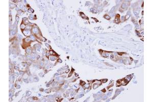 IHC-P Image Immunohistochemical analysis of paraffin-embedded H441 xenograft , using RAC1, antibody at 1:100 dilution. (RAC1 抗体  (Center))