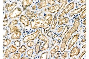 ABIN6257582 and ABIN6275689 at 1/100 staining Human kidney cancer and adjacent normal tissues by IHC-P. (ZFYVE19 抗体  (Internal Region))