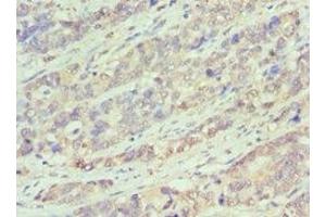 Immunohistochemistry of paraffin-embedded human endometrial cancer using ABIN7145167 at dilution of 1:100 (Cyclin D1 抗体  (AA 1-233))