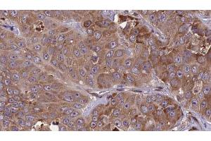 ABIN6273840 at 1/100 staining Human liver cancer tissue by IHC-P. (CCR1 抗体  (N-Term))