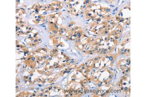 Immunohistochemistry of Human thyroid cancer using APOL6 Polyclonal Antibody at dilution of 1:50 (APOL6 抗体)