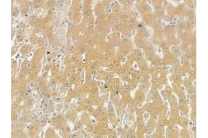 ABIN6257770 and ABIN6275494 at 1/100 staining human hepatocellular carcinoma by IHC-P. (ARHGEF10 抗体  (Internal Region))
