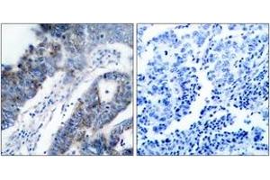 Immunohistochemistry analysis of paraffin-embedded human breast carcinoma tissue, using ASK1 (Ab-83) Antibody. (ASK1 抗体  (AA 49-98))