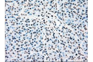 Immunohistochemical staining of paraffin-embedded Carcinoma of kidney tissue using anti-PLK1mouse monoclonal antibody. (PLK1 抗体)