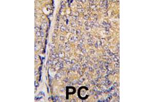 Formalin-fixed and paraffin-embedded human prostate carcinoma tissue reacted with STAP1 polyclonal antibody  , which was peroxidase-conjugated to the secondary antibody, followed by DAB staining. (STAP1 抗体  (Phe56))