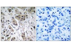 Immunohistochemical analysis of paraffin- embedded human breast carcinoma tissue, using Akt (phospho-Ser473) antibody (E011054). (AKT1 抗体  (pSer473))