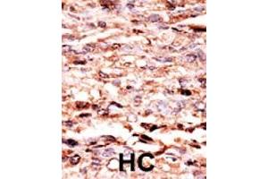 Formalin-fixed and paraffin-embedded human hepatocellular carcinoma tissue reacted with JUN (phospho S63) polyclonal antibody  which was peroxidase-conjugated to the secondary antibody followed by AEC staining. (C-JUN 抗体  (pSer63))