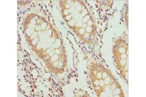 Immunohistochemistry of paraffin-embedded human colon cancer using ABIN7163635 at dilution of 1:100 (PLEKHA1 抗体  (AA 285-404))