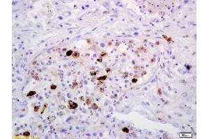 Formalin-fixed and paraffin embedded human lung carcinoma labeled with Anti-MRC1/CD206 Polyclonal Antibody, Unconjugated (ABIN1386219) at 1:200 followed by conjugation to the secondary antibody and DAB staining (Macrophage Mannose Receptor 1 抗体  (AA 201-300))