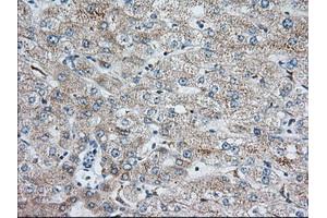 Immunohistochemical staining of paraffin-embedded Human liver tissue using anti-IGF2BP2 mouse monoclonal antibody. (IGF2BP2 抗体)