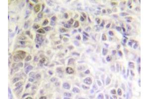 Immunohistochemistry analyzes of Ku70 antibody in paraffin-embedded human liver carcinoma tissue. (XRCC6 抗体)