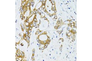 Immunohistochemistry of paraffin-embedded human colon carcinoma using SIRT2 antibody. (SIRT2 抗体)