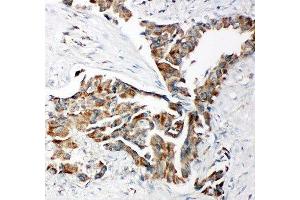 IHC-P: TRAM antibody testing of human lung cancer tissue (TICAM2 抗体  (C-Term))