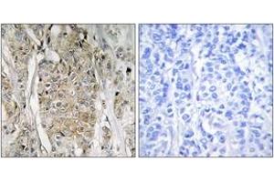 Immunohistochemistry analysis of paraffin-embedded human breast carcinoma tissue, using HER2 Antibody. (ErbB2/Her2 抗体  (AA 641-690))