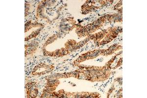 Immunohistochemical analysis of TUSC3 staining in human colon cancer formalin fixed paraffin embedded tissue section. (TUSC3 抗体  (Center))