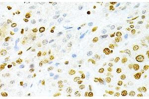 Immunohistochemistry of paraffin-embedded Human liver cancer using DKC1 Polyclonal Antibody at dilution of 1:200 (40x lens). (DKC1 抗体)