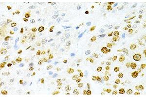 Immunohistochemistry of paraffin-embedded Human liver cancer using DKC1 Polyclonal Antibody at dilution of 1:200 (40x lens). (DKC1 抗体)