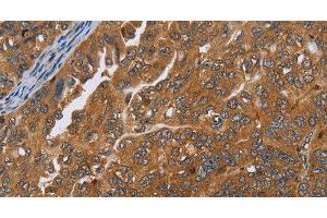 Immunohistochemistry of paraffin-embedded Human ovarian cancer tissue using ADAMTS15 Polyclonal Antibody at dilution 1:40 (ADAMTS15 抗体)