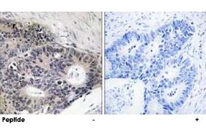 Immunohistochemistry analysis of paraffin-embedded human colon carcinoma tissue using ABHD12B polyclonal antibody . (ABHD12B 抗体)