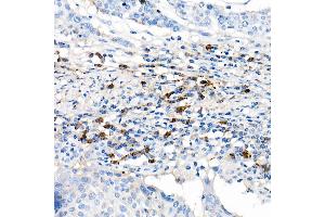 Immunohistochemistry of paraffin-embedded human cervix cancer using Lambda Light chain Rabbit mAb (ABIN7267847) at dilution of 1:100 (40x lens). (IGLV1-51 抗体)