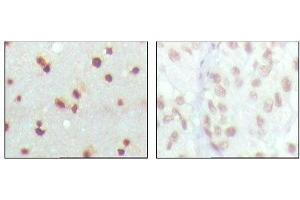 Immunohistochemical analysis of paraffin-embedded human cerebra (left) and lung carcinoma (right) tissues, showing nuclear localization with DAB staining using MDM4 mouse mAb. (MDM4-binding Protein 抗体)