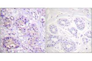 Immunohistochemistry analysis of paraffin-embedded human breast carcinoma, using IKK-beta (Phospho-Tyr199) Antibody. (IKBKB 抗体  (pTyr199))