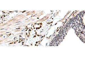 Immunohistochemistry of paraffin-embedded Human gastric cancer tissue using ARHGDIB Polyclonal Antibody at dilution of 1:35(x200) (ARHGDIB 抗体)