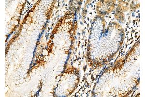 ABIN6262636 and ABIN6276998 at 1/100 staining Human gastric cancer and adjacent normal tissues by IHC-P.