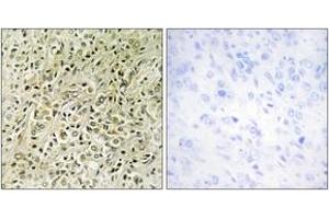 Immunohistochemistry analysis of paraffin-embedded human prostate carcinoma tissue, using RHG07 Antibody. (DLC1 抗体  (AA 61-110))