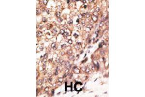 Formalin-fixed and paraffin-embedded human hepatocellular carcinoma tissue reacted with BMP7 polyclonal antibody  , which was peroxidase-conjugated to the secondary antibody, followed by DAB staining. (BMP7 抗体  (N-Term))