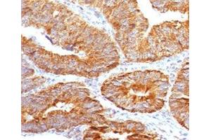 IHC testing of FFPE human colon carcinoma with TL1A antibody (clone TLRM1-1). (TNFSF15 抗体)