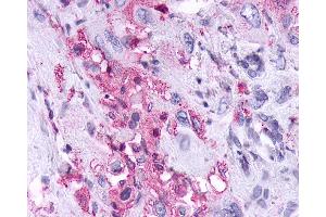 Anti-KISS1R / GPR54 antibody IHC of human Pancreas, Carcinoma. (KISS1R 抗体  (Cytoplasmic Domain))