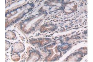 IHC-P analysis of Human Stomach Cancer Tissue, with DAB staining. (IL-10 抗体  (AA 19-178))