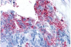 Human Colon Carcinoma (formalin-fixed, paraffin-embedded) stained with GPR124 antibody ABIN213374 at 11 ug/ml followed by biotinylated goat anti-rabbit IgG secondary antibody ABIN481713, alkaline phosphatase-streptavidin and chromogen. (GPR124 抗体  (N-Term))
