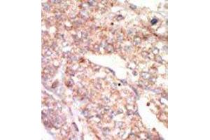 Formalin-fixed and paraffin-embedded human cancer tissue reacted with the primary antibody, which was peroxidase-conjugated to the secondary antibody, followed by AEC staining. (EPHA1 抗体  (N-Term))