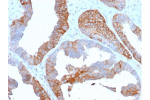 Formalin-fixed, paraffin-embedded human Prostate Carcinoma stained with HLA-DR Mouse Monoclonal Antibody (TAL 1B5). (HLA-DR 抗体)