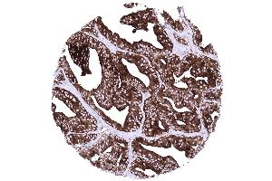 Prostate Prostatic adenocarcinoma Gleason 448 with strong diffuse PSAP positivity (Recombinant Prosaposin 抗体)