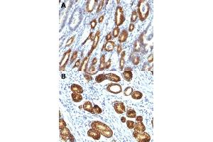 Immunohistochemical staining (Formalin-fixed paraffin-embedded sections) of human gastric carcinoma (A, B) with MUC6 monoclonal antibody, clone MUC6/916 . (MUC6 抗体)