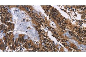 Immunohistochemistry of paraffin-embedded Human colon cancer tissue using EPHB6 Polyclonal Antibody at dilution 1:50 (EPH Receptor B6 抗体)