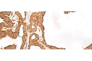 Immunohistochemistry of paraffin-embedded Human thyroid cancer tissue using GBGT1 Polyclonal Antibody at dilution of 1:40(x200) (GBGT1 抗体)