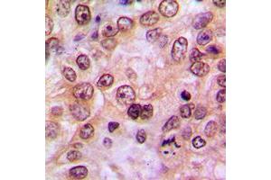 Immunohistochemical analysis of LIMK1/2 (pT508/505) staining in human breast cancer formalin fixed paraffin embedded tissue section. (LIMK-1/2 (C-Term), (pSer505), (pSer508) 抗体)