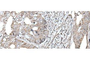 Immunohistochemistry of paraffin-embedded Human colorectal cancer tissue using RAD54B Polyclonal Antibody at dilution of 1:45(x200) (RAD54B 抗体)