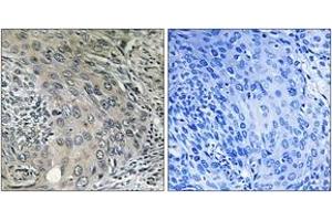 Immunohistochemistry analysis of paraffin-embedded human cervix carcinoma tissue, using COPZ1 Antibody. (COPZ1 抗体  (AA 11-60))